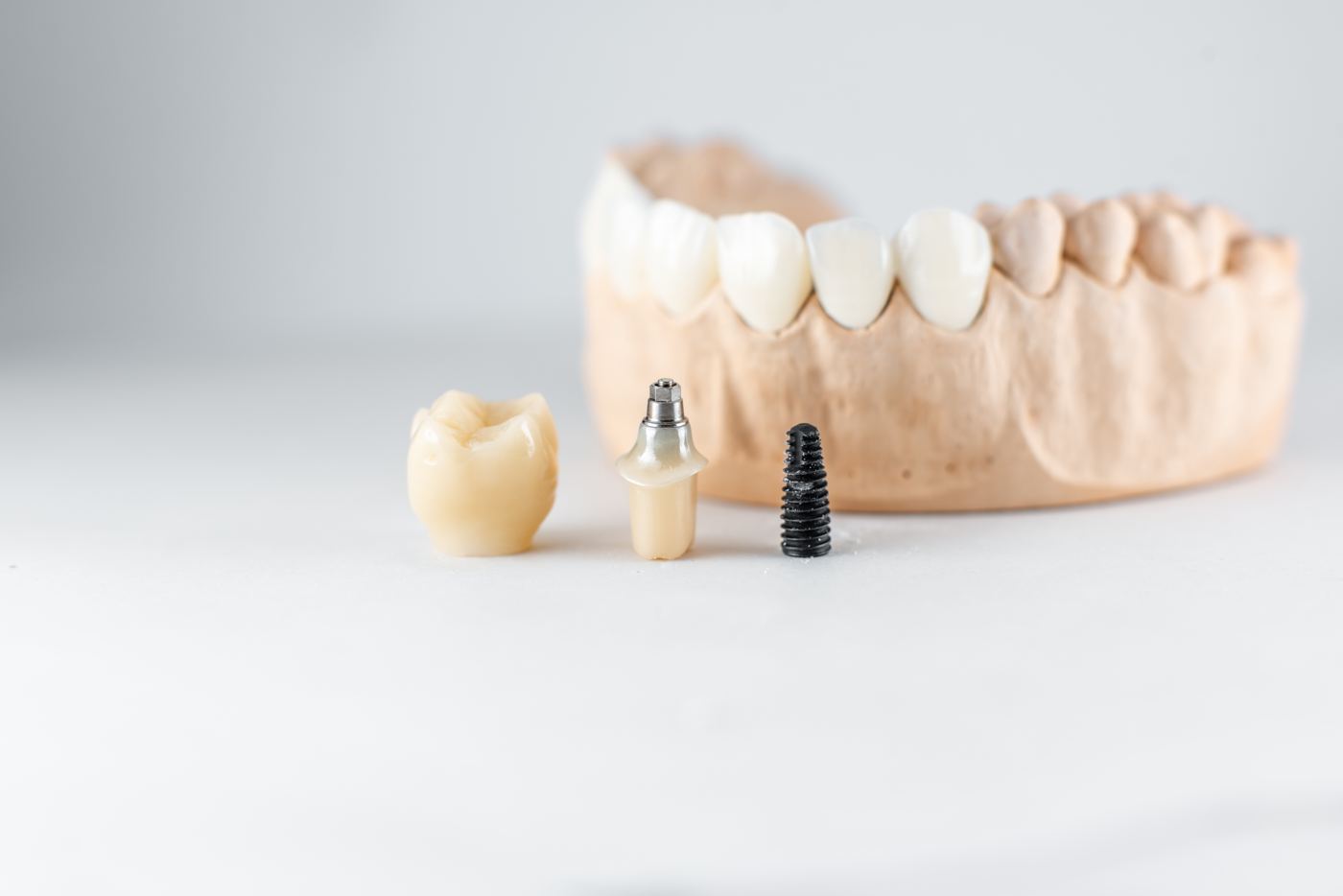 Implante dental, pilar y corona de zirconio junto a un modelo dental
