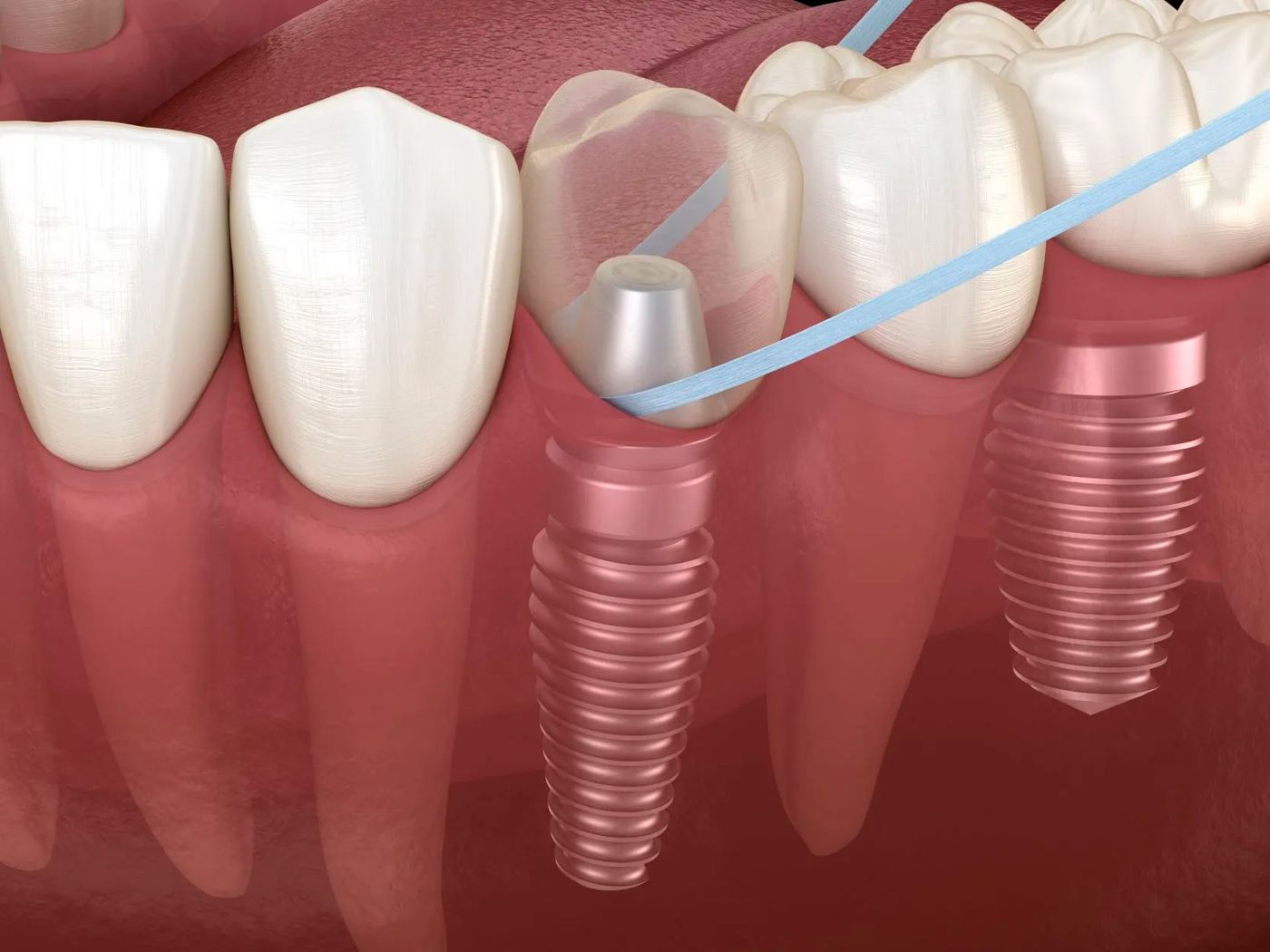 Implantes dentales integrados en la encía junto a dientes naturales